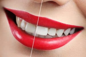 שיניים צהובות – הסיבות ודרכי הטיפול האפשריות