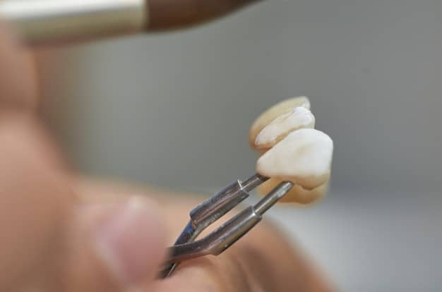 כתרים לשיניים – מה גם אתם צריכים לדעת?